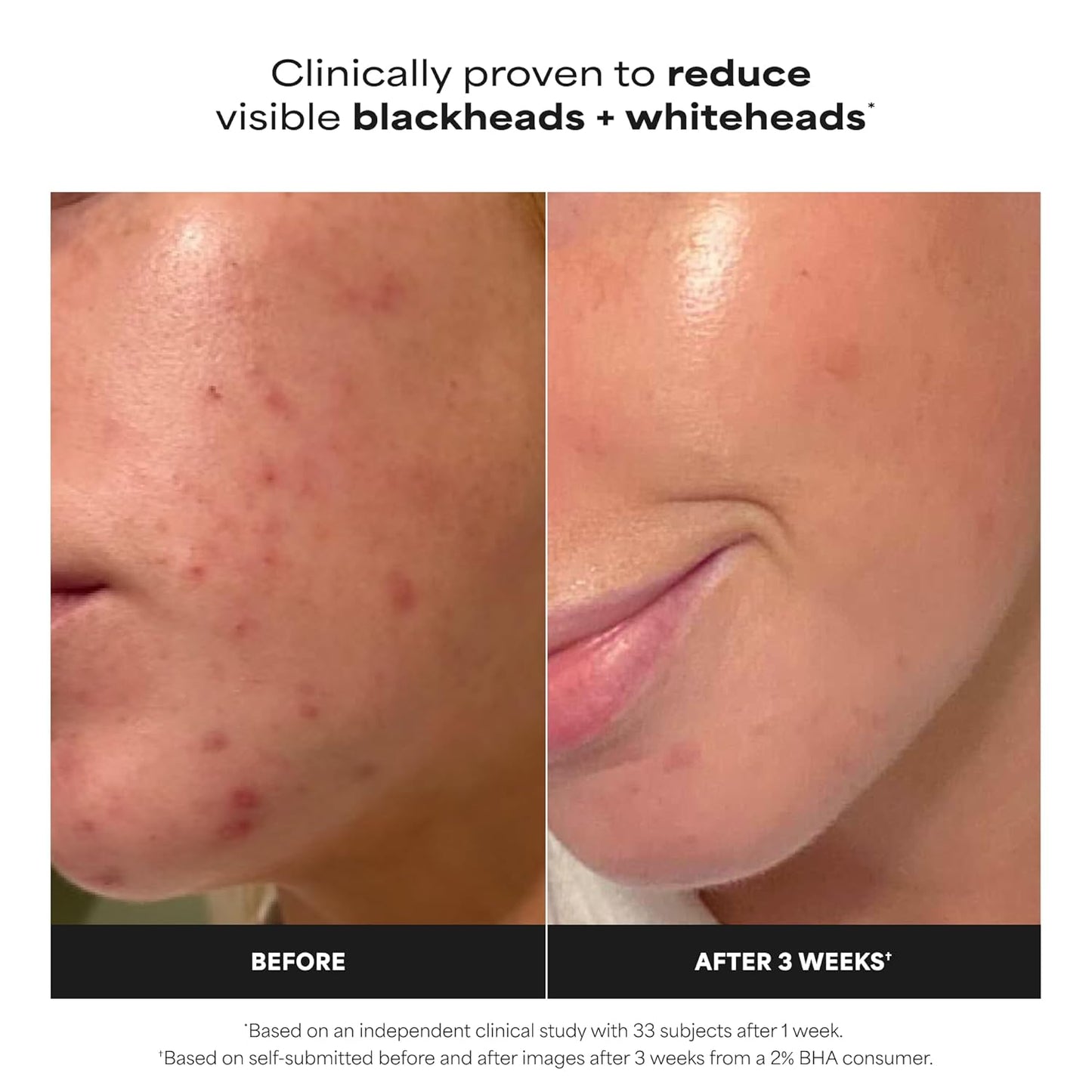 Skin Perfecting 2% BHA Liquid Exfoliant (4 fl oz)